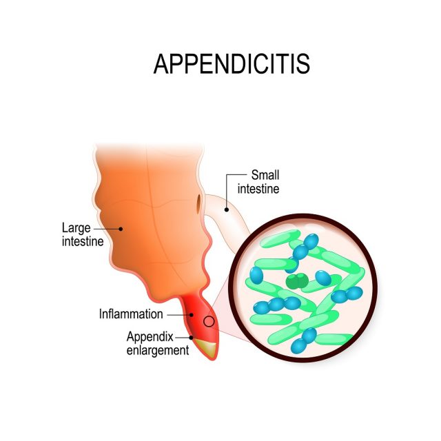 Appendicitis Symptoms In Women