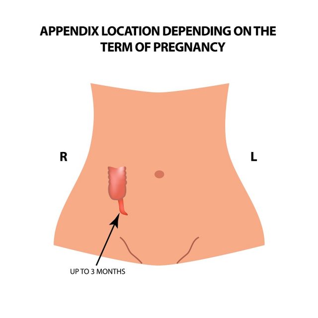 Appendicitis Symptoms In Women