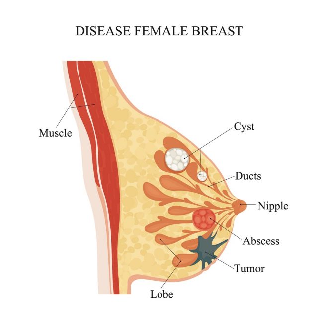 Breast Infections