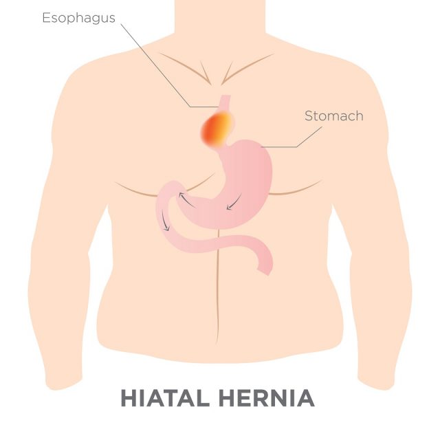 Heartburn in Women