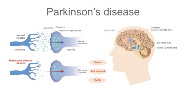 Degenerative Nerve Disease