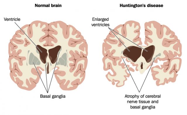 Degenerative Nerve Disease