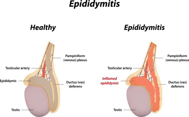 Chronic Epididymitis