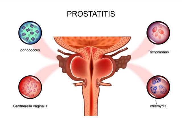 Chronic Epididymitis