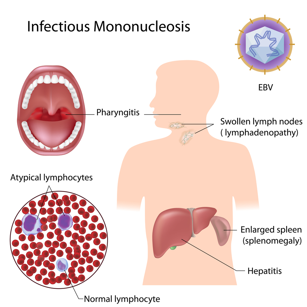 Инфекционный мононуклеоз (вирус Эпштейна-Барр)