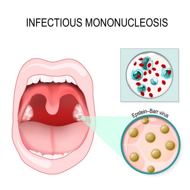 Epstein Barr Virus