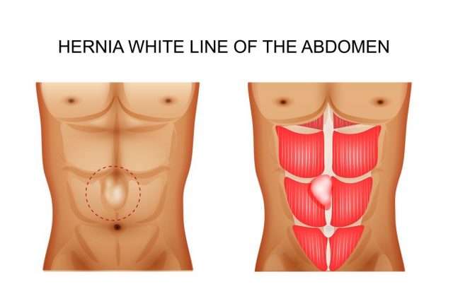 Hernia Symptoms in a Male