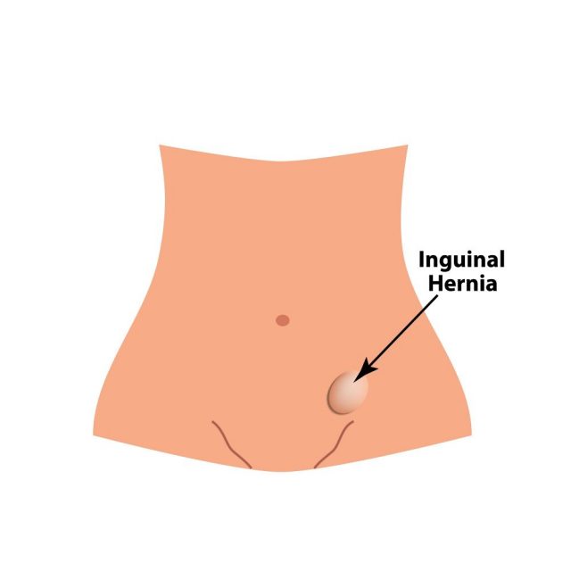 Hernia Symptoms in a Male