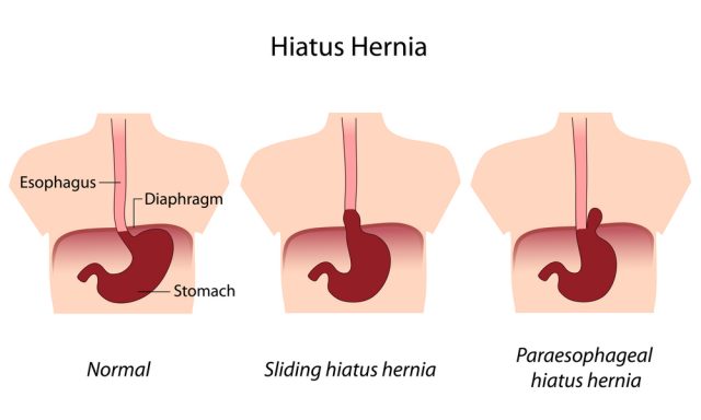 Hernia Symptoms in a Male