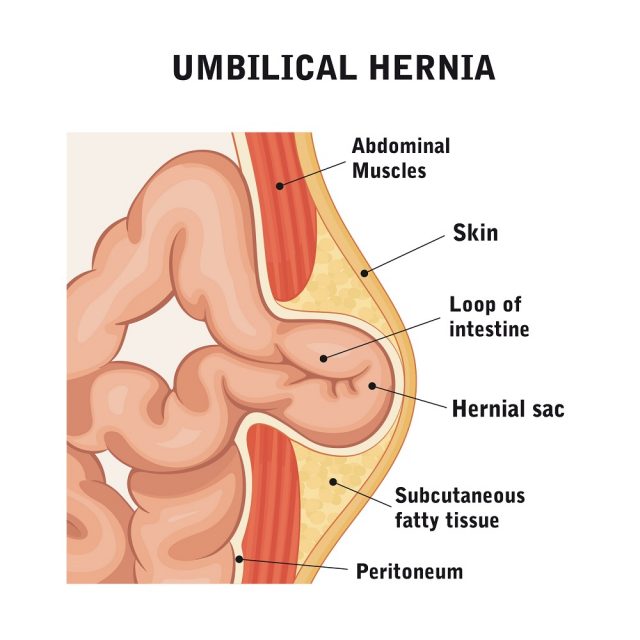 Hernia Symptoms in a Male