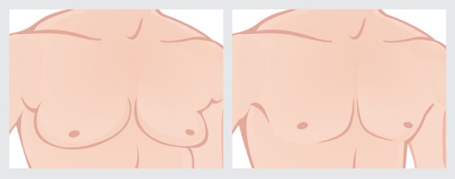 Natural Ways to Reduce Male Breast Size