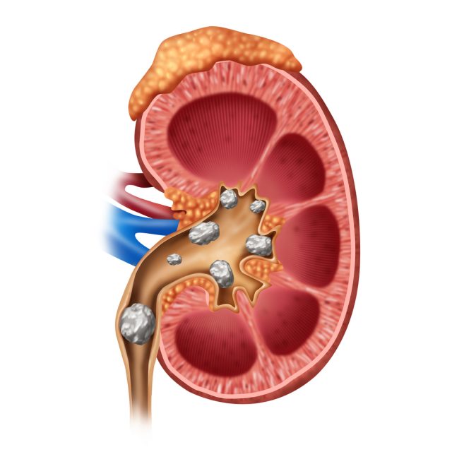 Male Signs of Kidney Stones