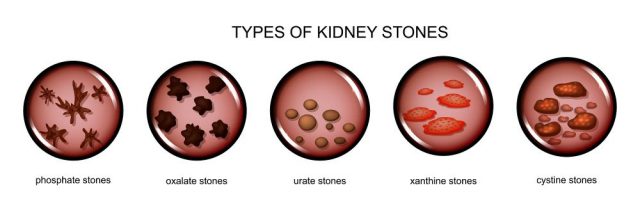 Male Signs of Kidney Stones