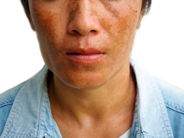 Melasma