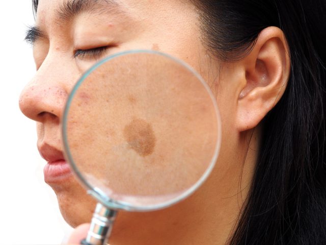 Melasma