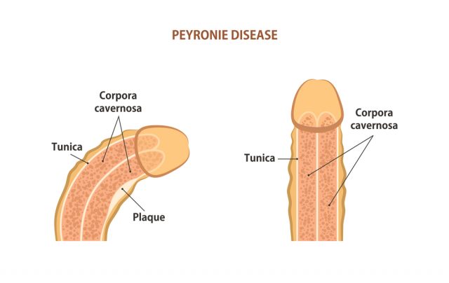 Peyronie's Disease