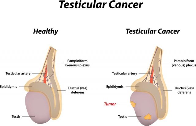 Swollen Testicles