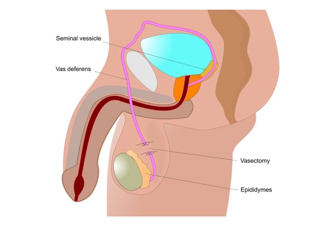 Swollen Testicles