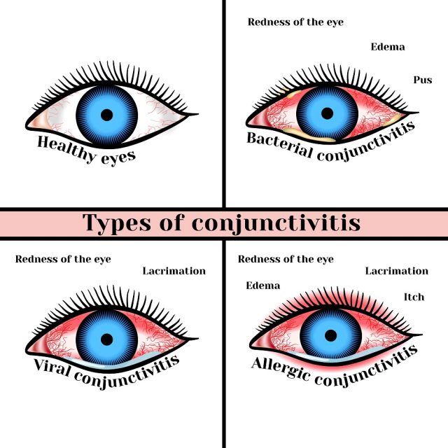 Viral Eye Infection Types, Symptoms, Treatment STD.GOV Blog