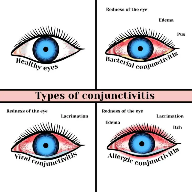 Viral Eye Infection Types, Symptoms, Treatment STD.GOV Blog