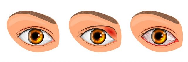Viral Eye Infection