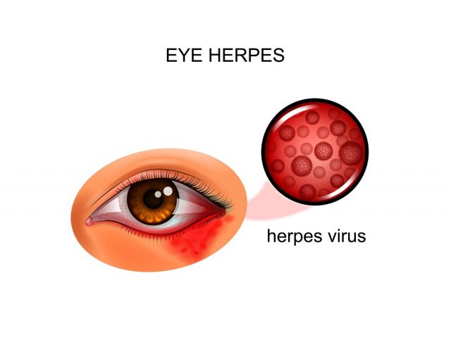 Viral Eye Infection