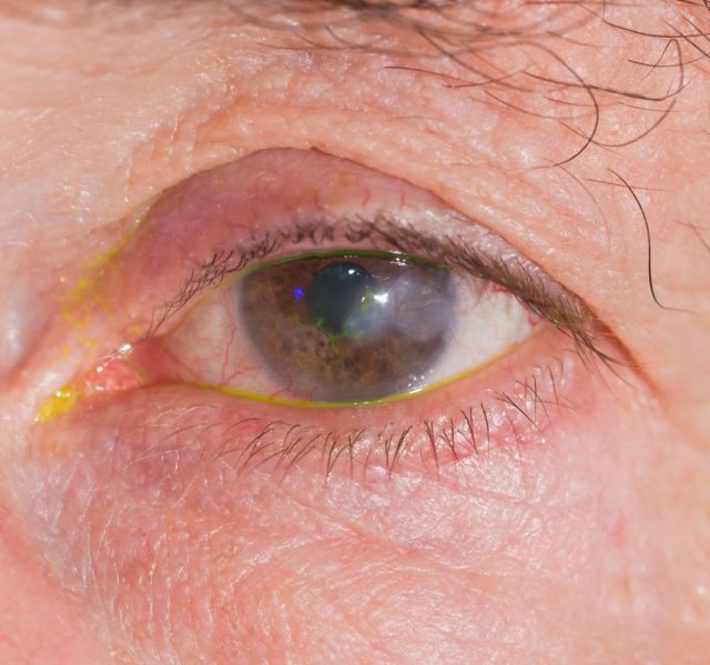 Viral Eye Infection Types, Symptoms, Treatment STD.GOV Blog