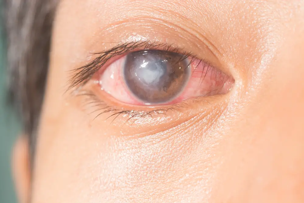 Viral Eye Infection Types, Symptoms, Treatment STD.GOV Blog