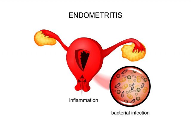 Chronic Endometritis