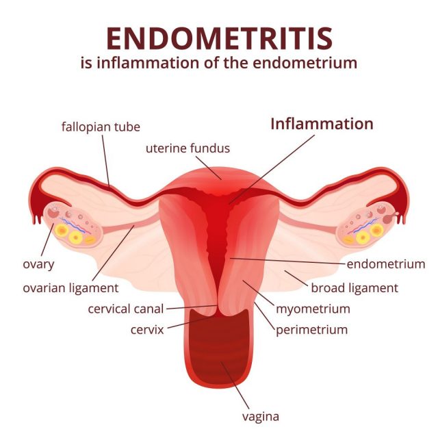 Chronic Endometritis