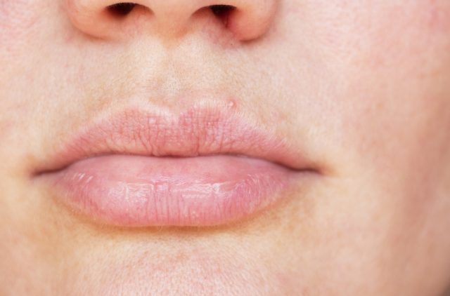 Causes Of The White Bumps On Lips Stdgov Blog