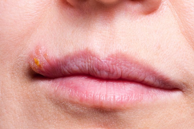 Causes of the White Bumps on Lips | STD.GOV Blog