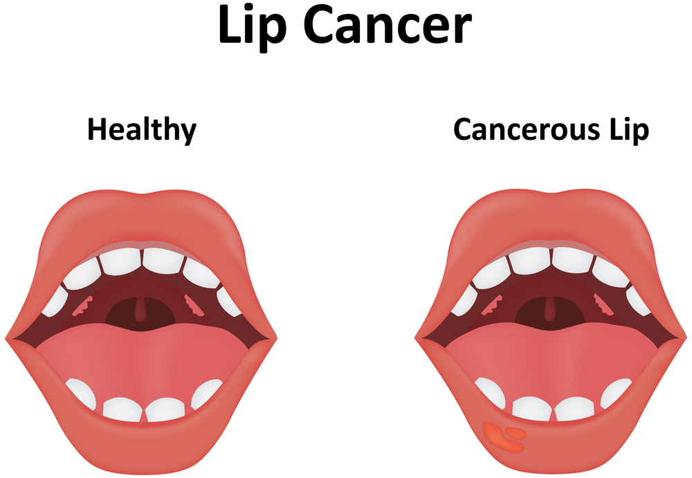 Causes Of The White Bumps On Lips Stdgov Blog