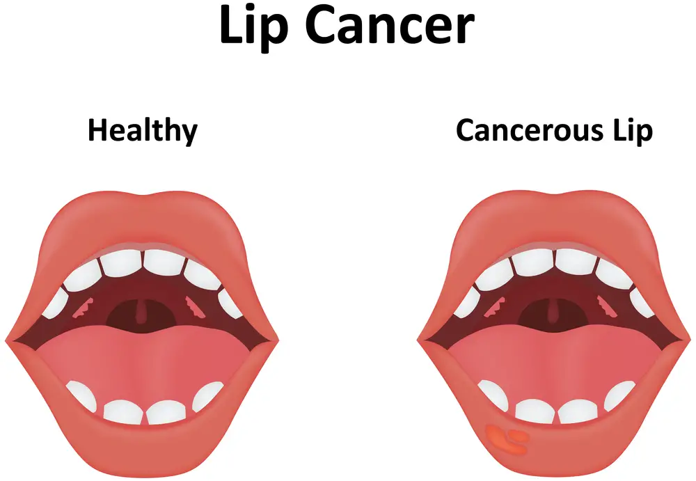 Causes of the White Bumps on Lips | STD.GOV Blog