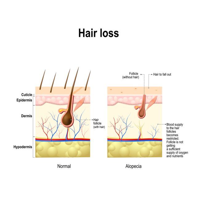 What Causes Bald Patches On The Scalp?