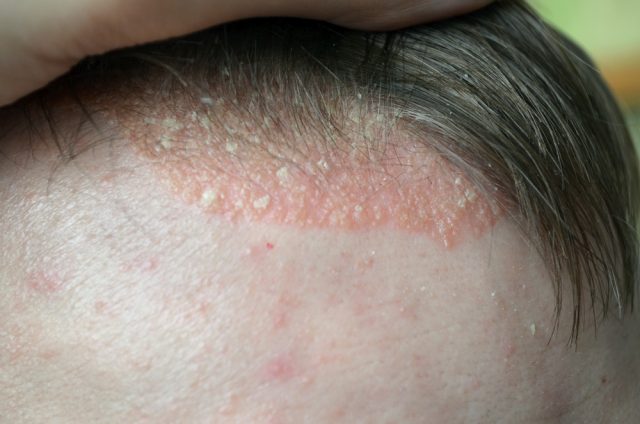 What Causes Bald Patches On The Scalp?