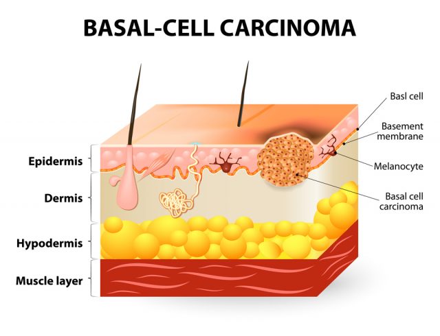Types of Skin Cancer