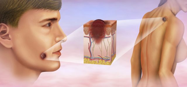 Types of Skin Cancer