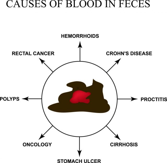 reasons for blood in stool
