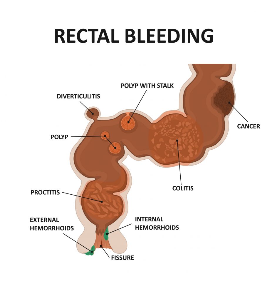 Rectal Bleeding And Bleeding From The Rectum Causes And Diagnosis The Best Porn Website