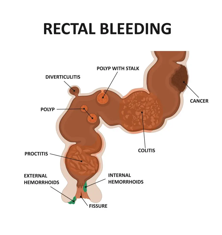 Rectal Bleeding And Bleeding From The Rectum Causes And Diagnosis The