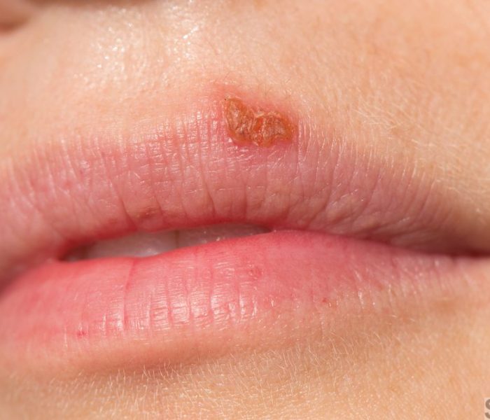 Oral herpes on upper lip of a woman
