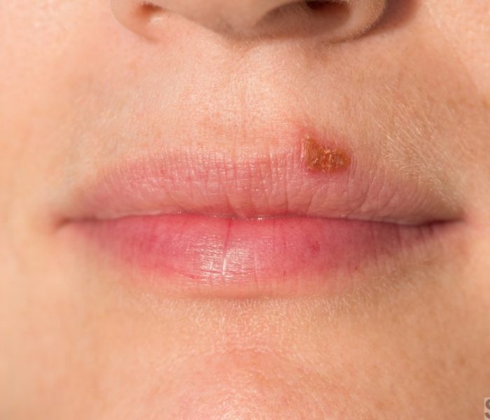 Oral herpes on upper lip of a woman