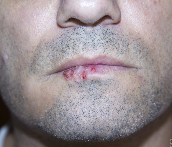 A man infected with oral herpes