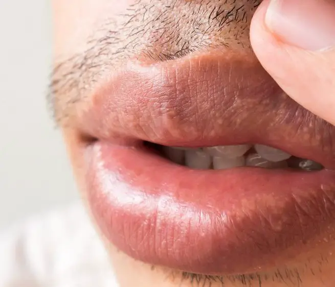 Closeup of lips man problem health care, Herpes simplex