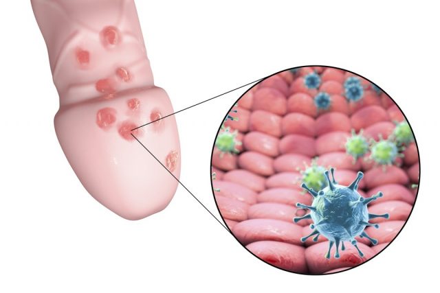 HSV-II (Genital Herpes)