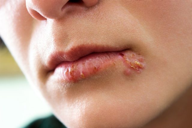 Herpes infection on the lips of a girl