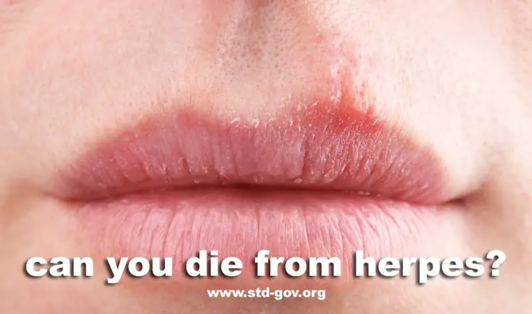 Can You Die From Herpes Std Gov Blog