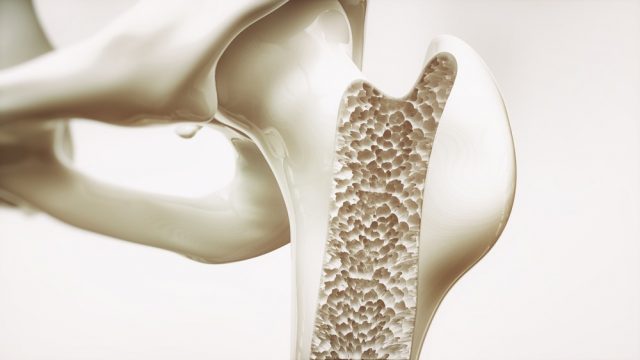 Osteoporosis stage 4 of 4 - upper limb bones - 3d rendering