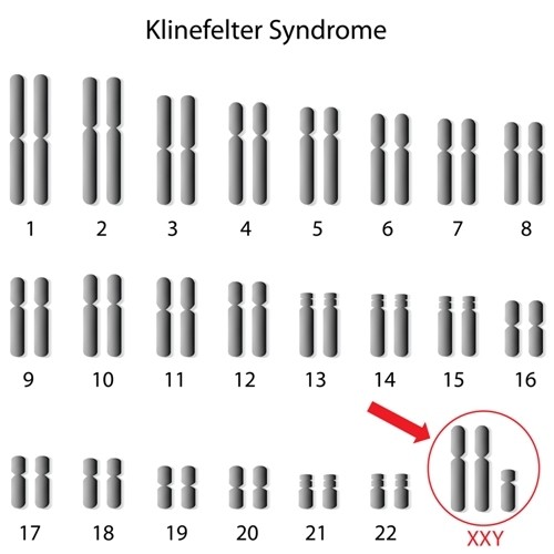Klinefelter syndrome
